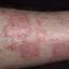 400. Eczema Hands Pictures