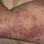 401. Eczema Hands Pictures