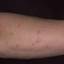 409. Eczema Hands Pictures