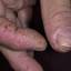 41. Eczema Hands Pictures