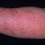 410. Eczema Hands Pictures