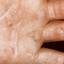 423. Eczema Hands Pictures