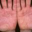 427. Eczema Hands Pictures
