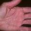 431. Eczema Hands Pictures