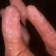 432. Eczema Hands Pictures
