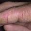 44. Eczema Hands Pictures