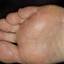 440. Eczema Hands Pictures