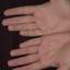 443. Eczema Hands Pictures