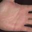 448. Eczema Hands Pictures