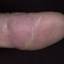 453. Eczema Hands Pictures