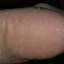 457. Eczema Hands Pictures