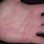 459. Eczema Hands Pictures