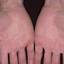 461. Eczema Hands Pictures