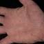 462. Eczema Hands Pictures