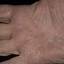 464. Eczema Hands Pictures