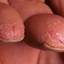 47. Eczema Hands Pictures
