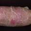 55. Eczema Hands Pictures