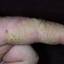 56. Eczema Hands Pictures