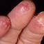 62. Eczema Hands Pictures