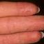 63. Eczema Hands Pictures