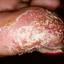 65. Eczema Hands Pictures