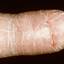 68. Eczema Hands Pictures