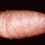 69. Eczema Hands Pictures