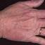 71. Eczema Hands Pictures