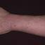9. Eczema Hands Pictures