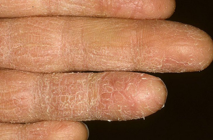 Eczema Bumps On Hands