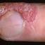 2. Bacterial Eczema Pictures