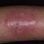 21. Bacterial Eczema Pictures