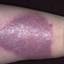 24. Bacterial Eczema Pictures