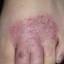 3. Bacterial Eczema Pictures