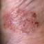 35. Bacterial Eczema Pictures