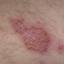 40. Bacterial Eczema Pictures