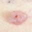 10. Basal Cell Carcinoma Pictures