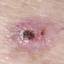 11. Basal Cell Carcinoma Pictures
