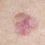 12. Basal Cell Carcinoma Pictures
