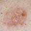 14. Basal Cell Carcinoma Pictures