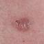 15. Basal Cell Carcinoma Pictures