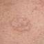17. Basal Cell Carcinoma Pictures