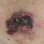 19. Basal Cell Carcinoma Pictures