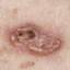 20. Basal Cell Carcinoma Pictures
