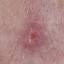 21. Basal Cell Carcinoma Pictures