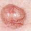 22. Basal Cell Carcinoma Pictures