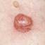23. Basal Cell Carcinoma Pictures