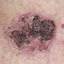 25. Basal Cell Carcinoma Pictures