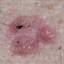 26. Basal Cell Carcinoma Pictures