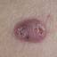 27. Basal Cell Carcinoma Pictures